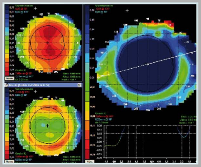 orthokeratology corneal topography